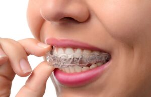 Teeth Aligners